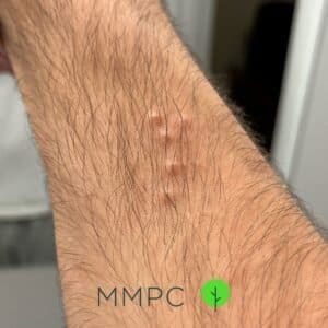 bed bug bites on arm