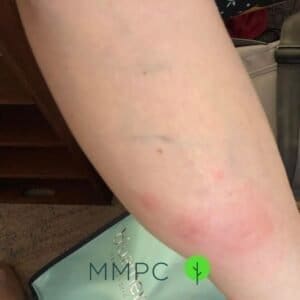 bed bug bites on calf