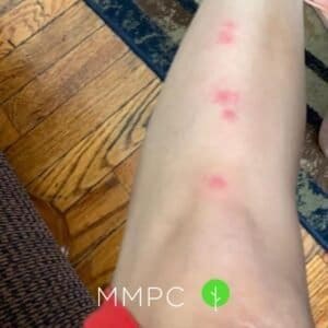 bed bug bites on leg