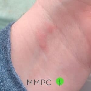 bed bug bites on wrist