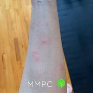 bed bug bites on arm
