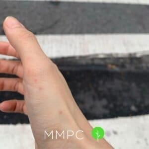 bed bug bites on hand
